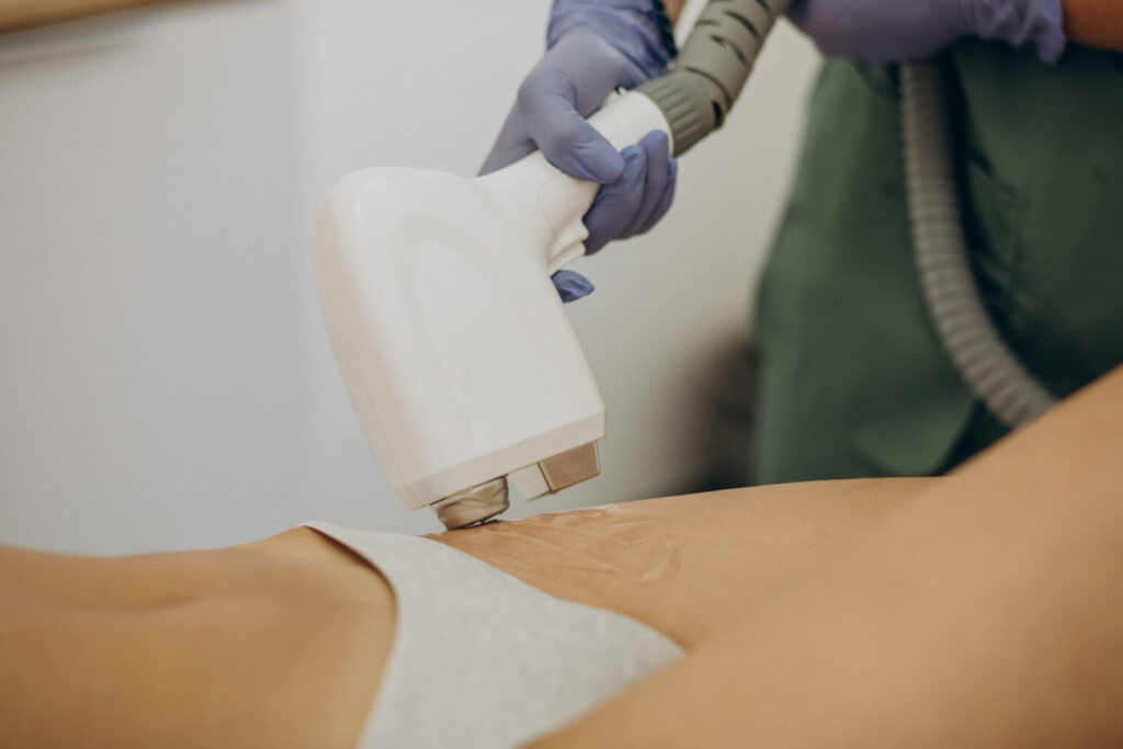 épilation laser