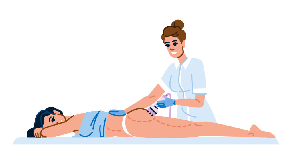 Illustration de la zone du SIF (sillon inter-fessier) pour un témoignage sur l'épilation laser.