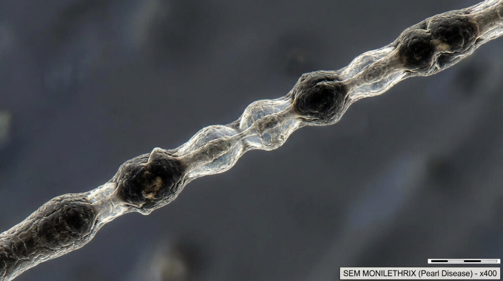 Vue microscopique d'une tige pilaire atteinte de la maladie de la perle, montrant l'alternance régulière de renflements et d'étranglements qui fragilisent la fibre