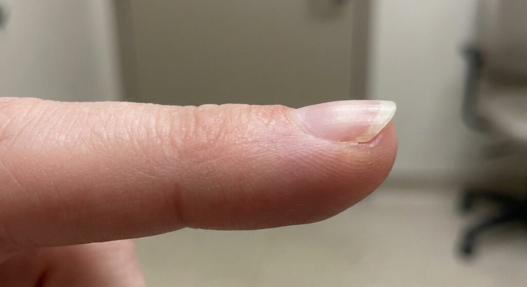 Vue de profil d'un ongle naturel présentant une déformation en tremplin vers le haut